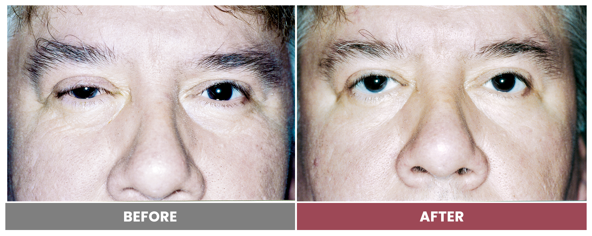 PTOSIS REPAIR - Case 6